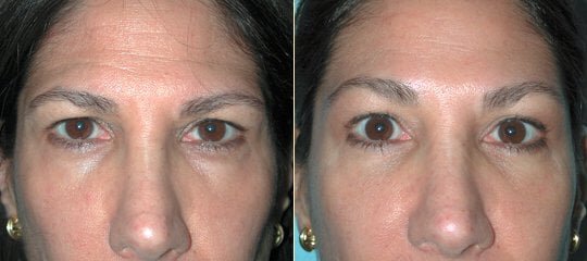Sydney brow lift patient before and after