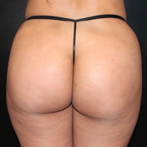 Fat Transfer to the Buttocks Before & After Image