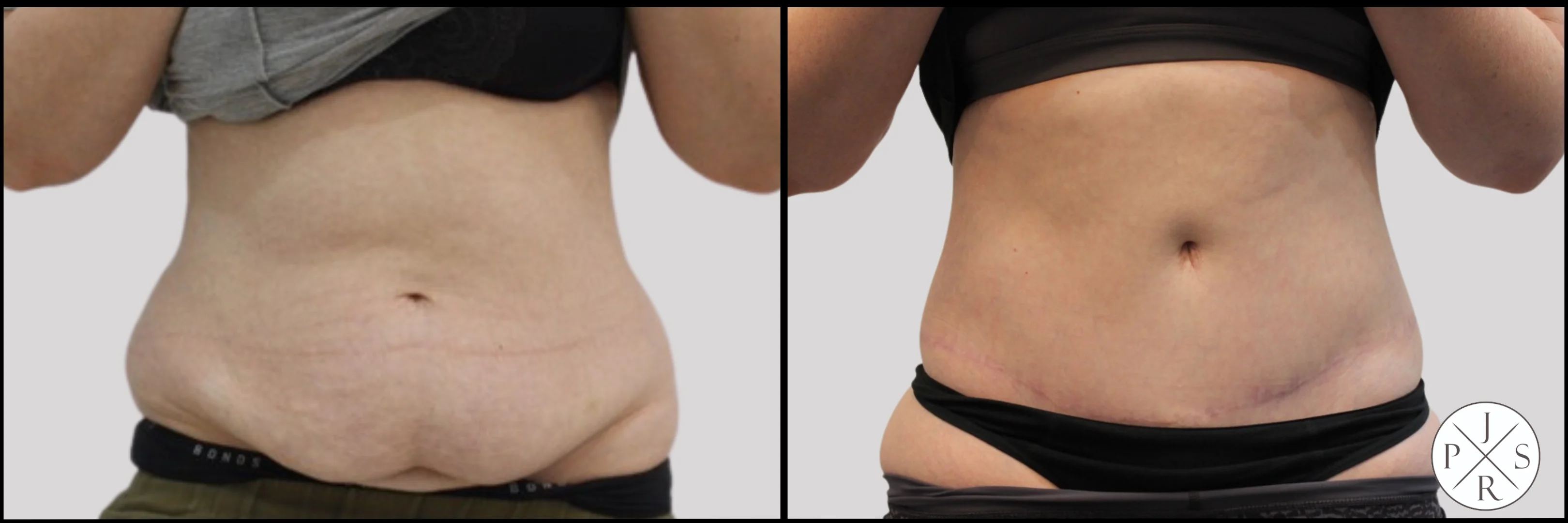 Abdominoplasty Before & After - Front View