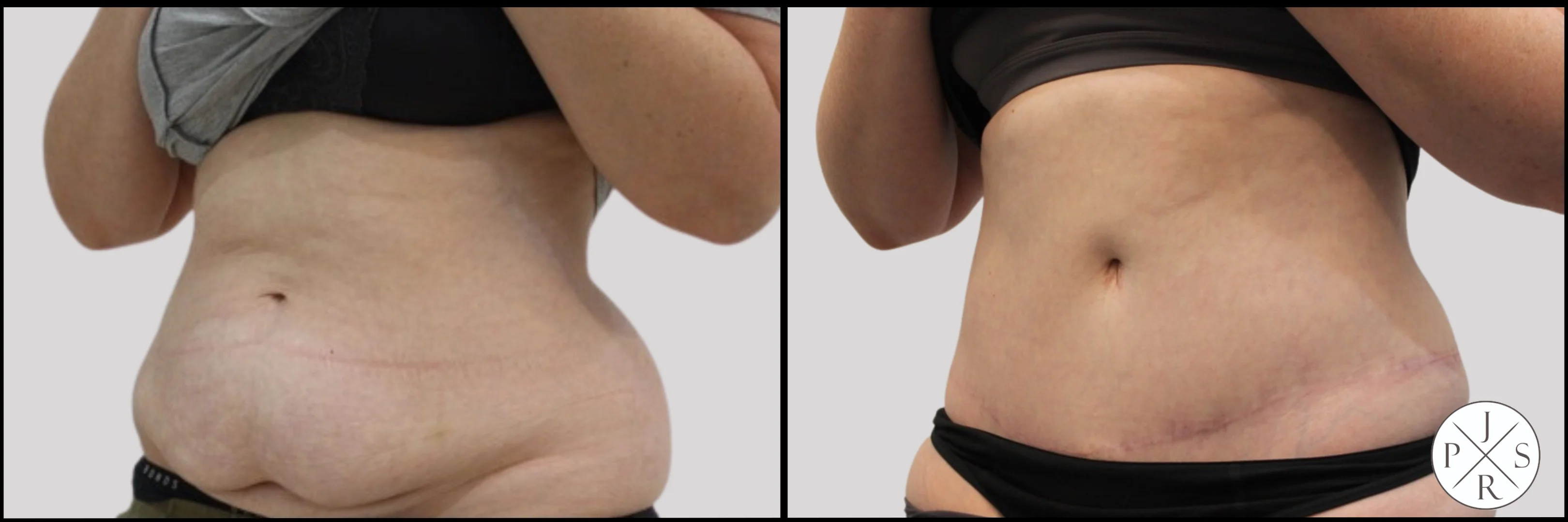 Abdominoplasty Before & After - Side View