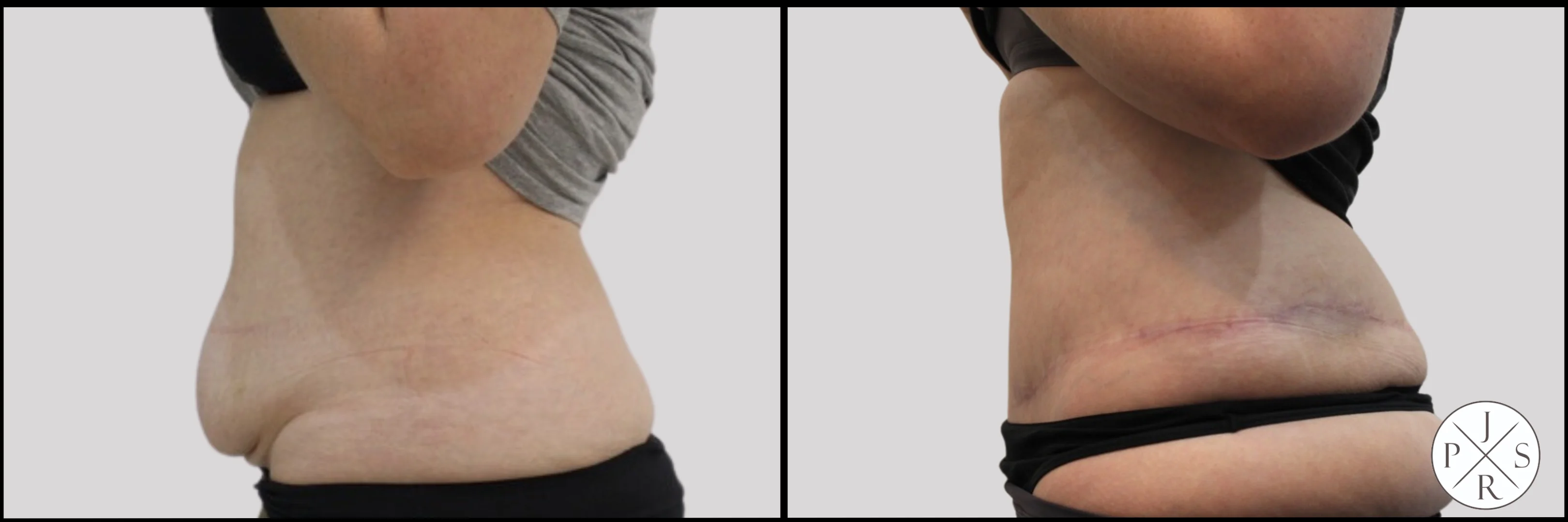 Abdominoplasty Before & After - Angled View