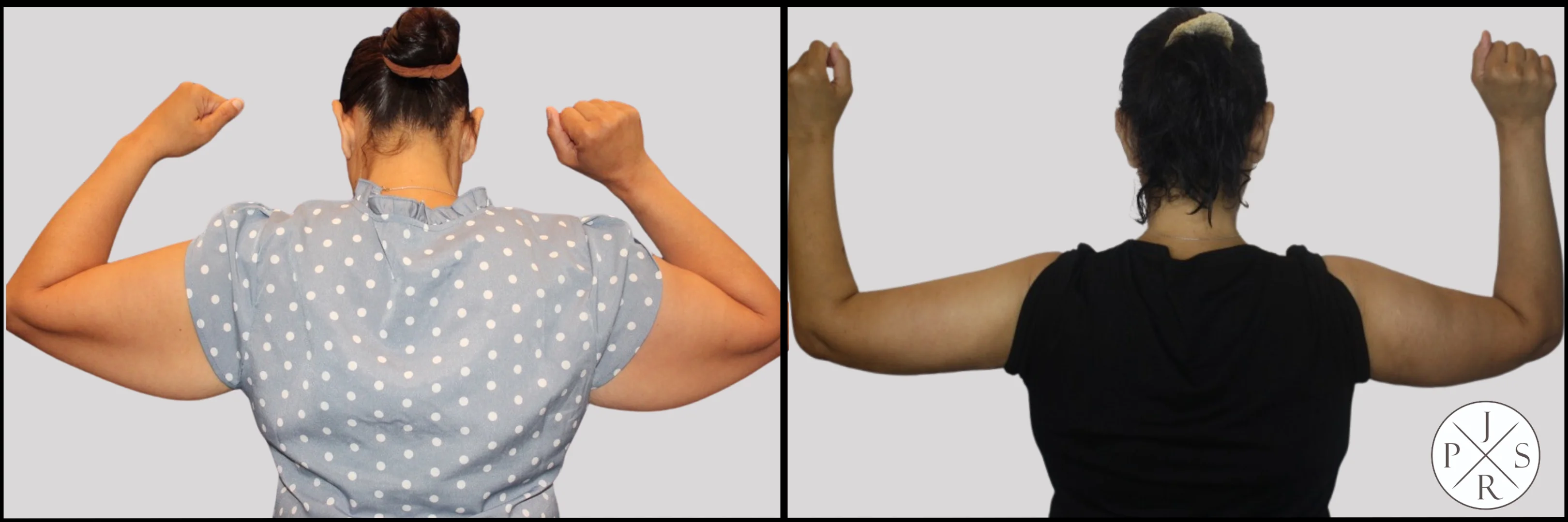 Brachioplasty Before & After - Front View