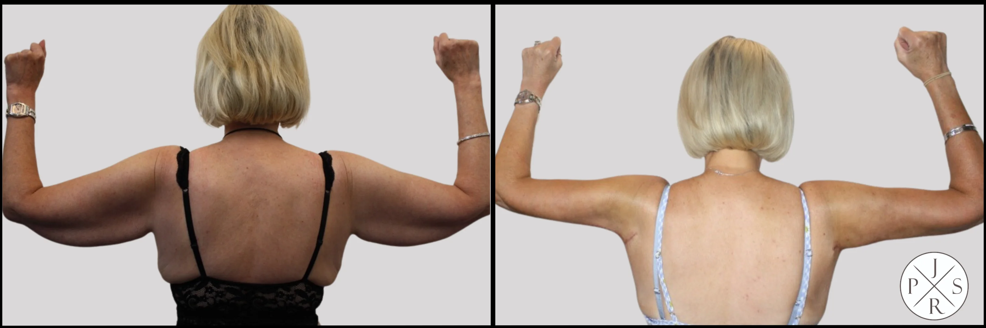 Brachioplasty Before & After - Side View