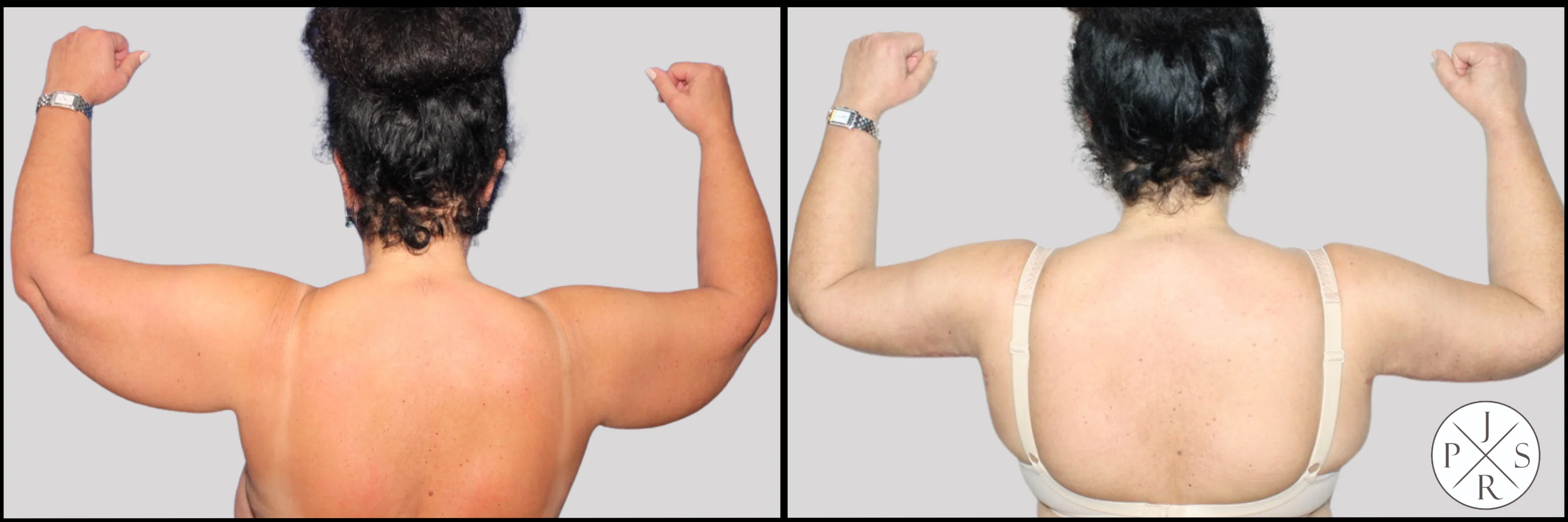 Brachioplasty Before & After - Angled View