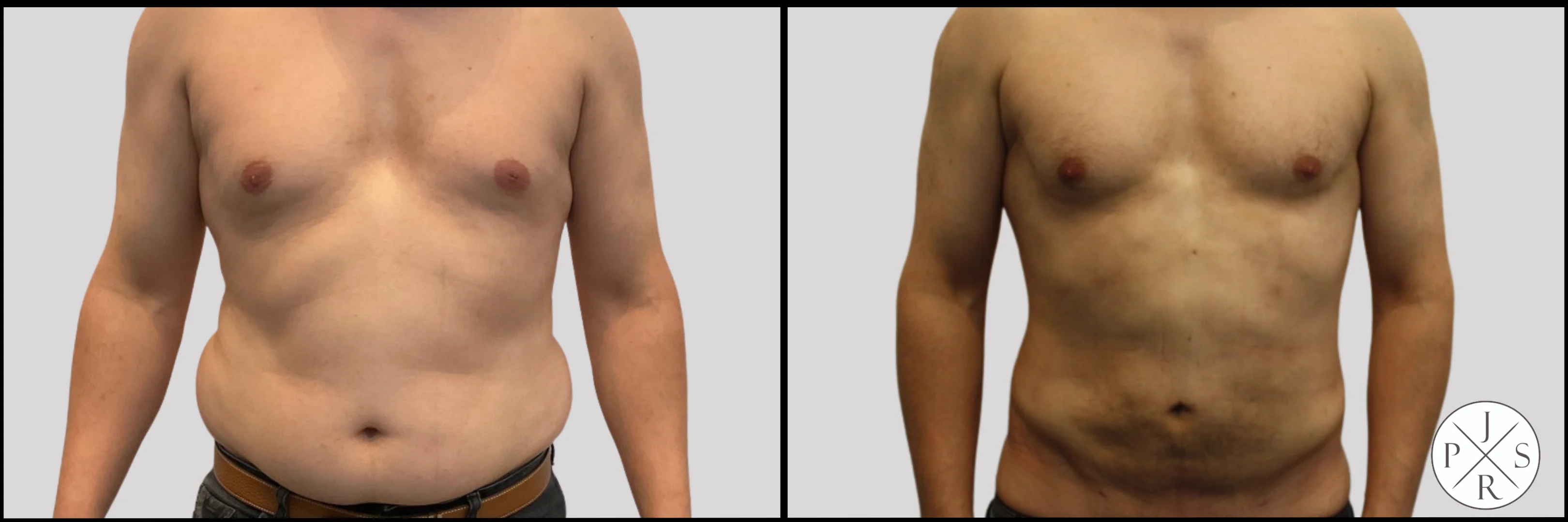Liposuction Before & After - Patient 1, View 1