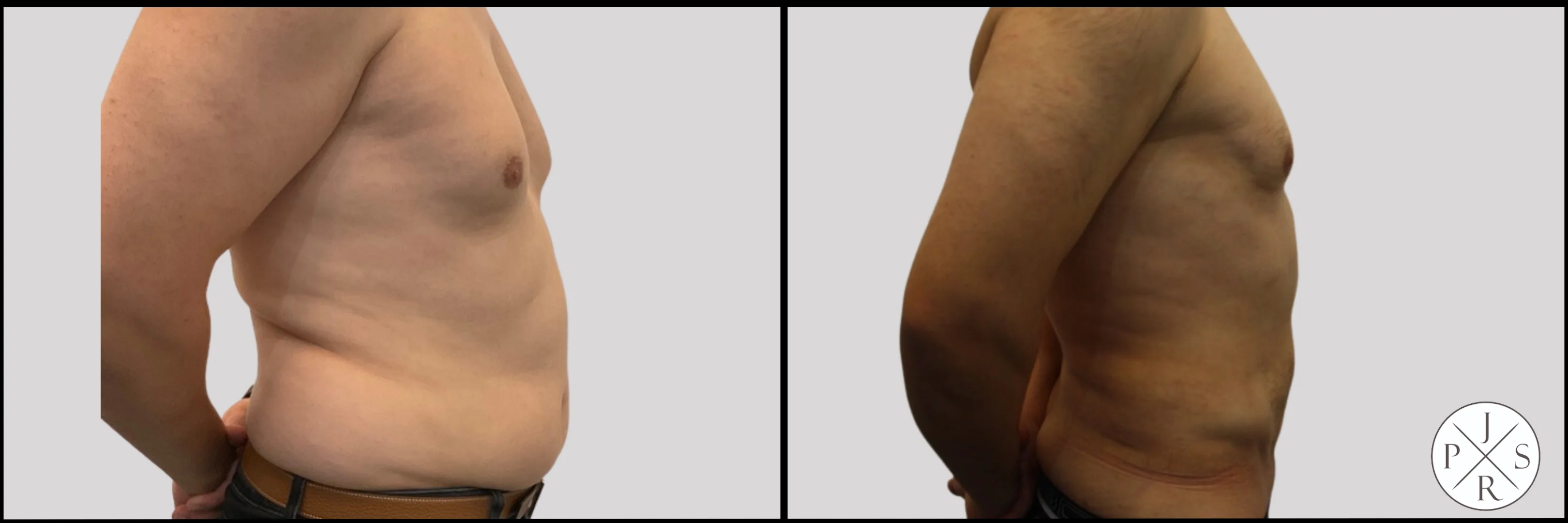 Liposuction Before & After - Patient 1, View 2