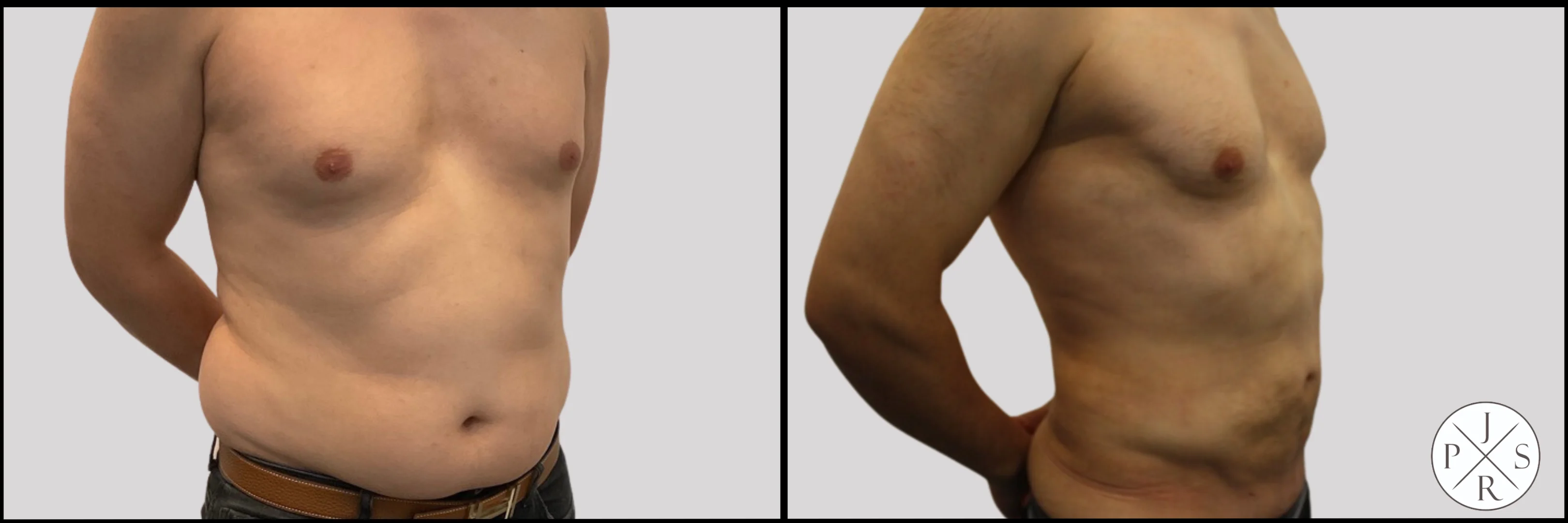 Liposuction Before & After - Patient 1, View 3