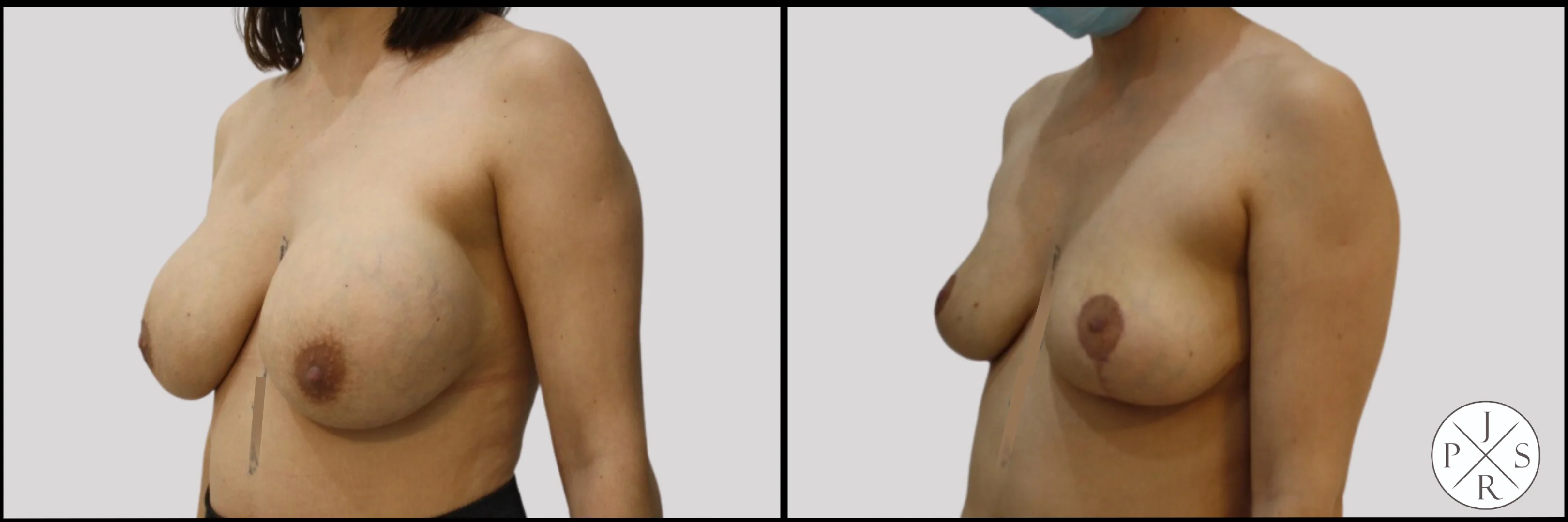 Breast Implant Removal Before & After - Side View