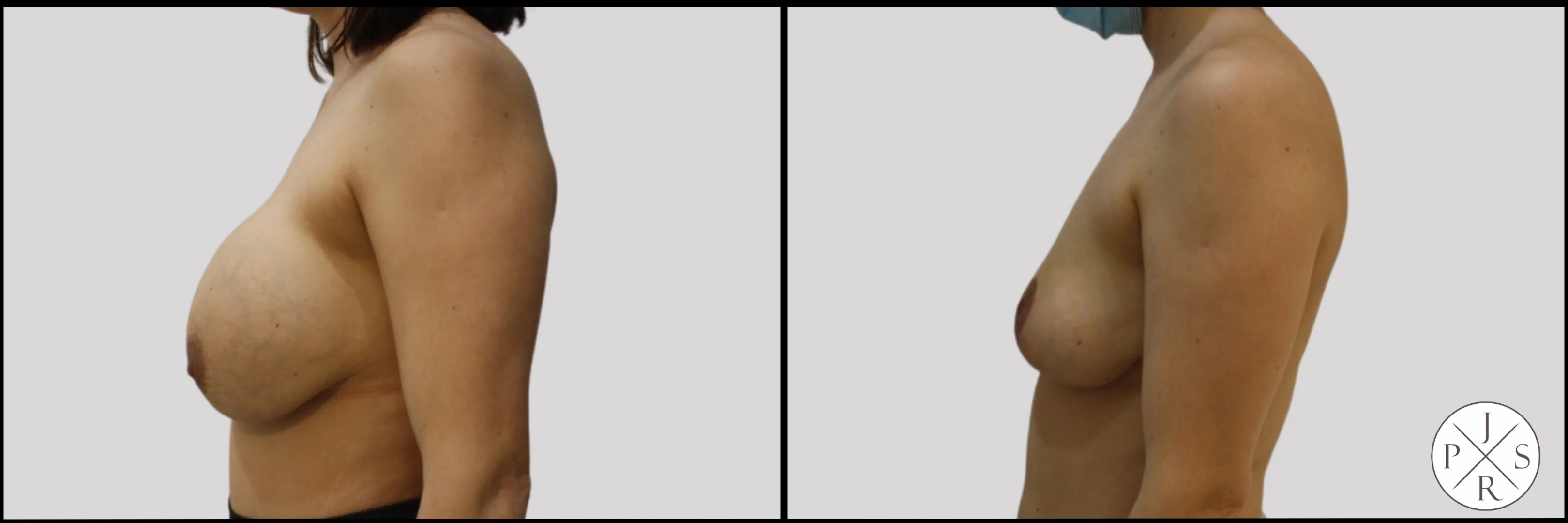Breast Implant Removal Before & After - Angled View