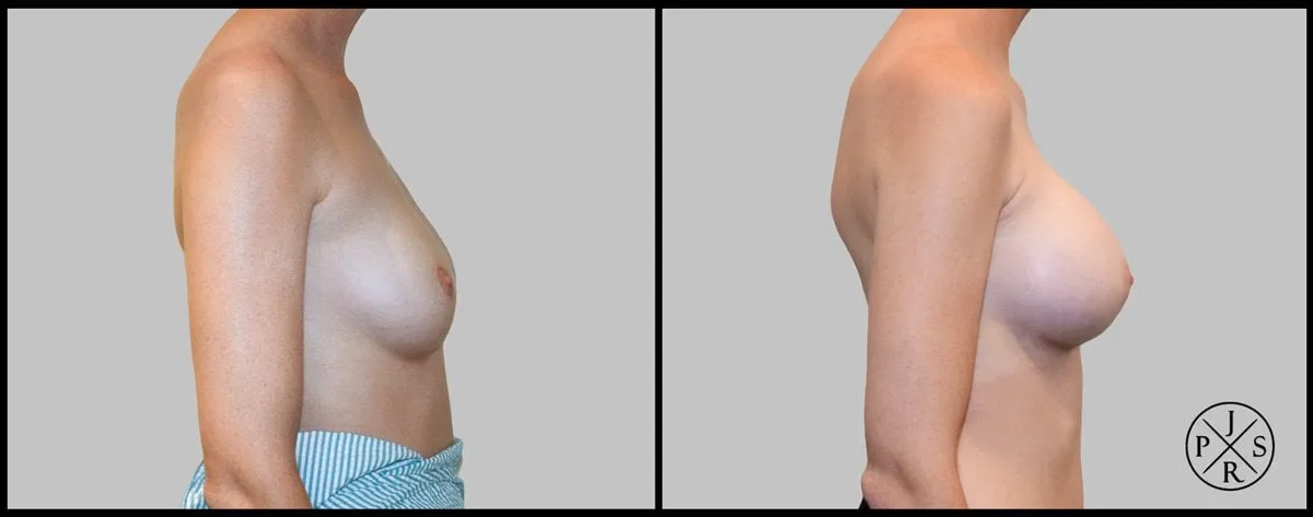 Breast Augmentation Before & After - Patient 1, View 2