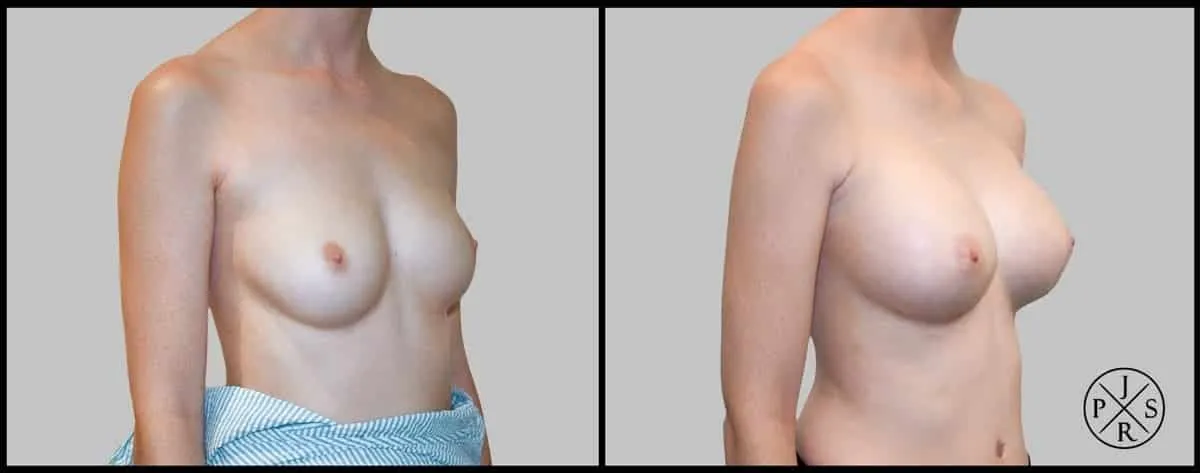 Breast Augmentation Before & After - Patient 1, View 3