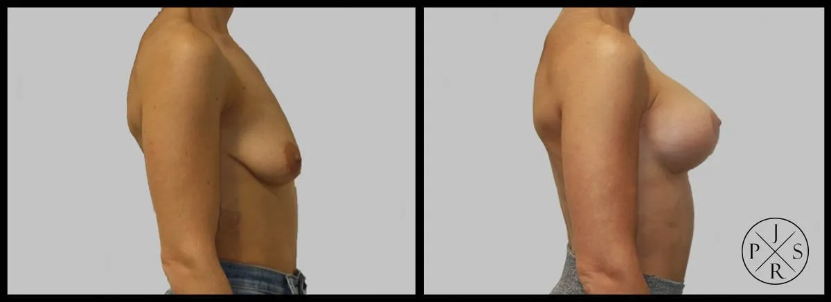 Breast Lift Before & After - Patient 1, View 2
