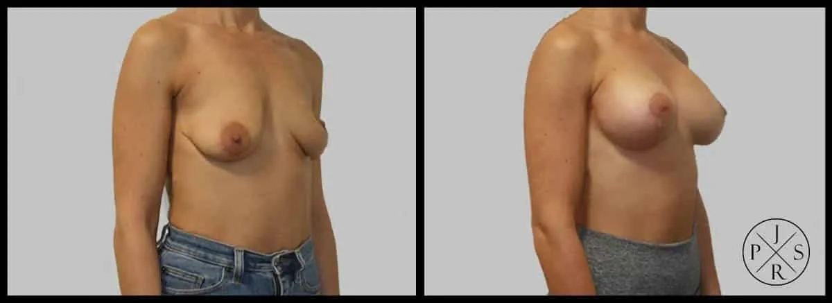 Breast Lift Before & After - Patient 1, View 3