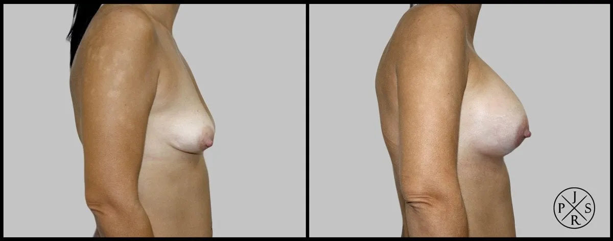 Breast Reconstruction Before & After - Before
