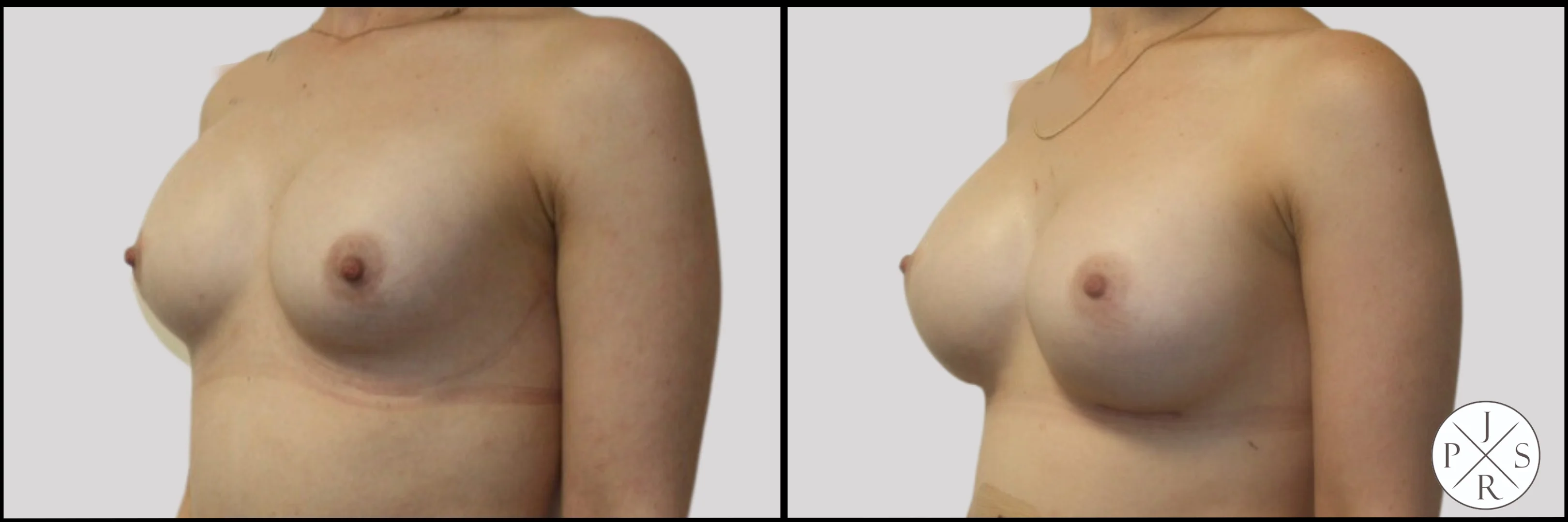 Breast Revision Before & After Image