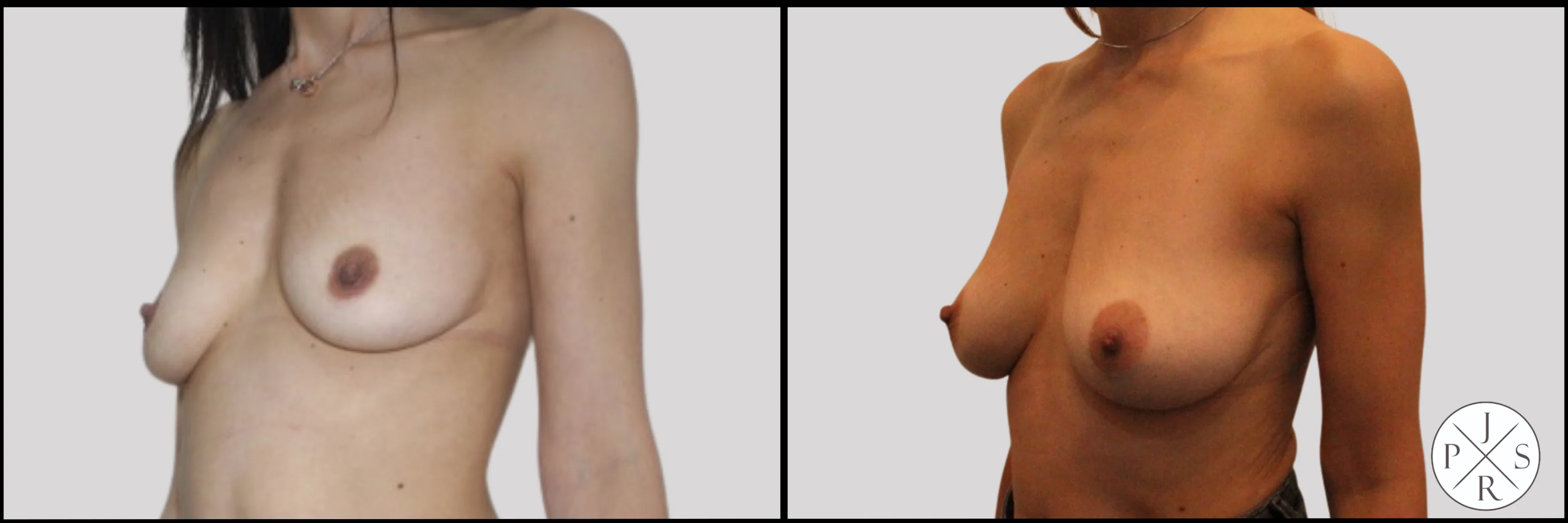 Fat Transfer Breast Augmentation Before & After - Side View