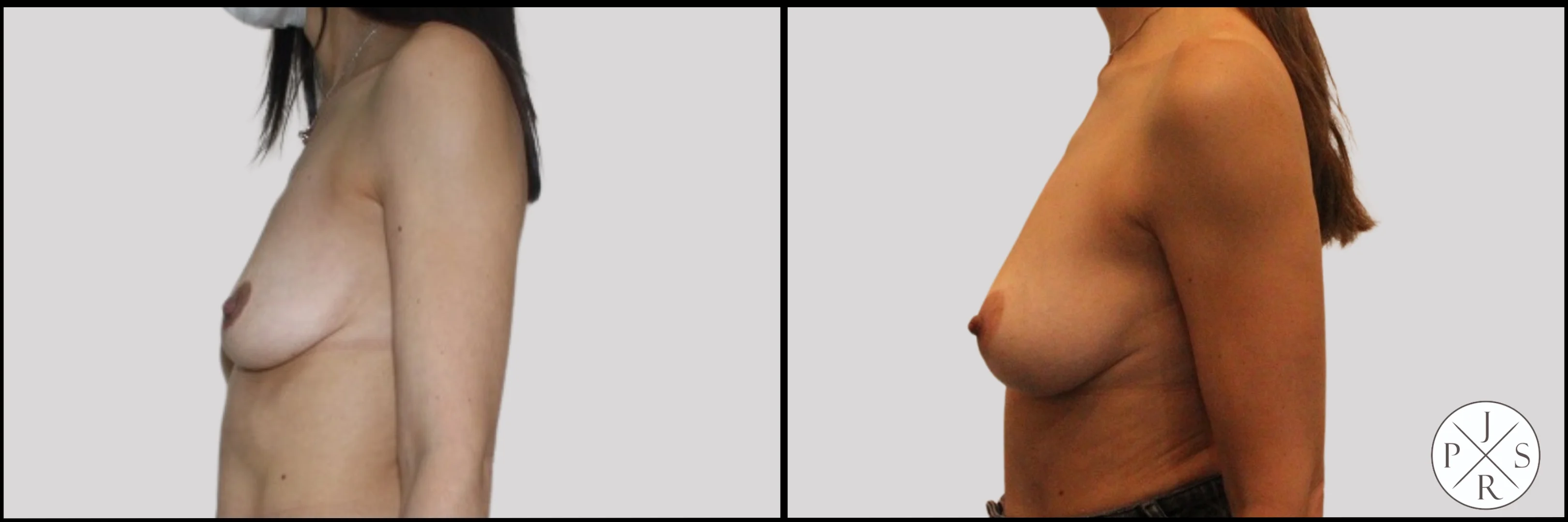 Fat Transfer Breast Augmentation Before & After - Angled View