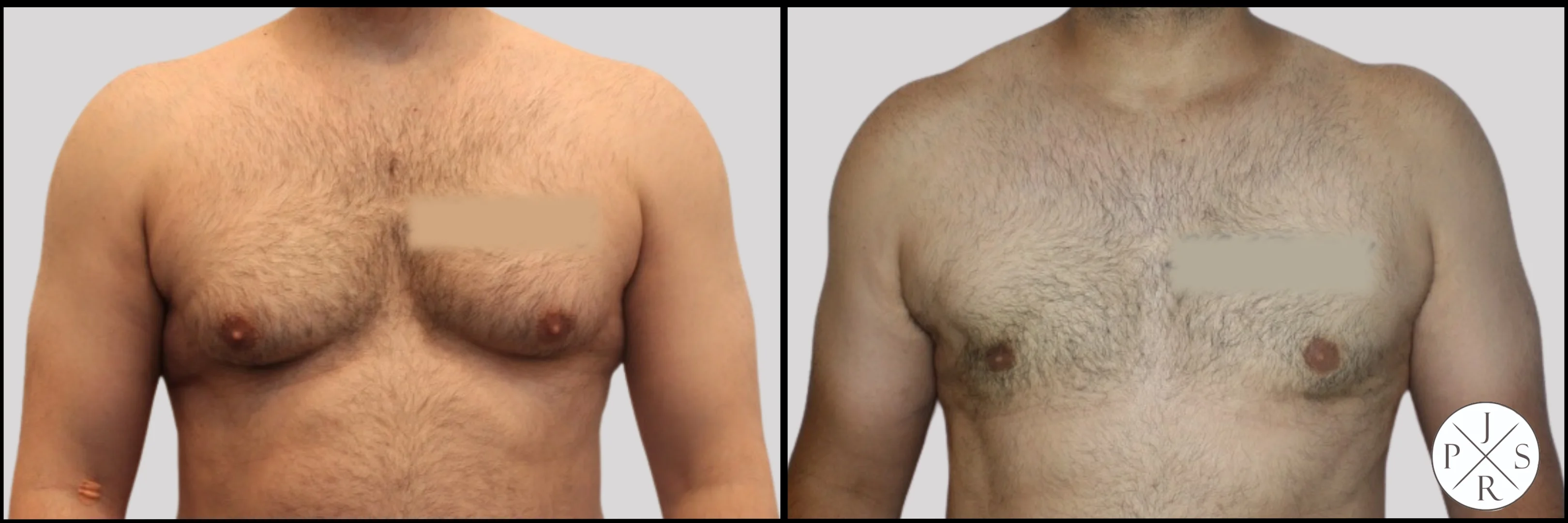 Gynaecomastia Before & After Image