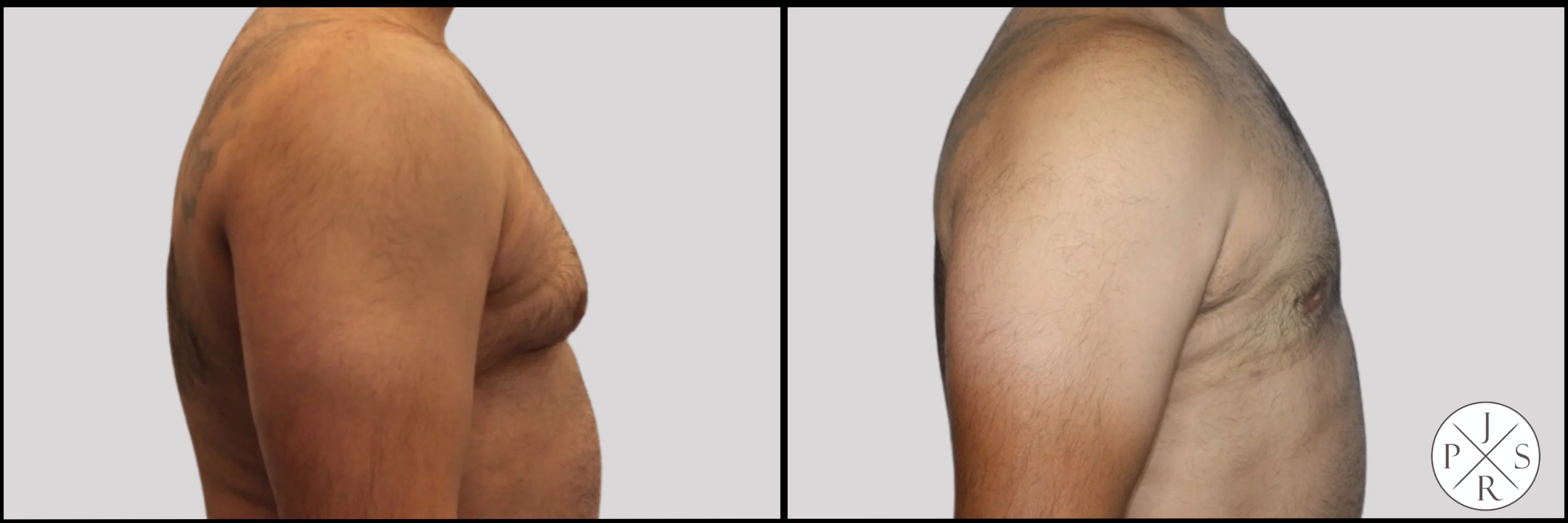 Gynaecomastia Before & After Image