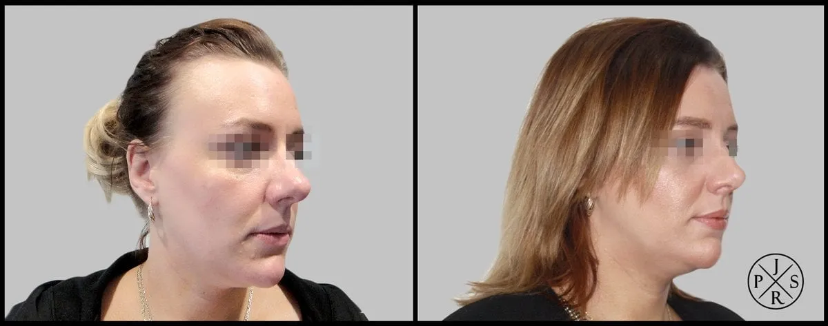 Rhinoplasty Before & After - Before