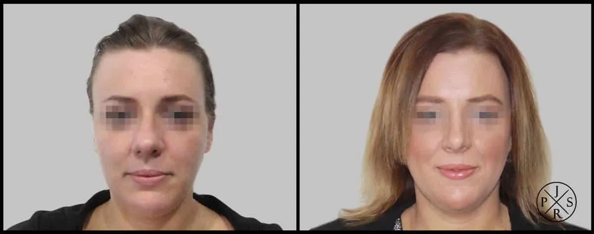 Rhinoplasty Before & After - After