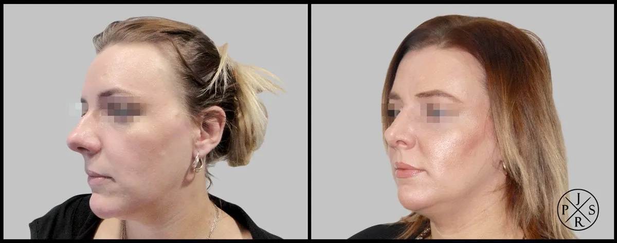 Rhinoplasty Before & After - Before