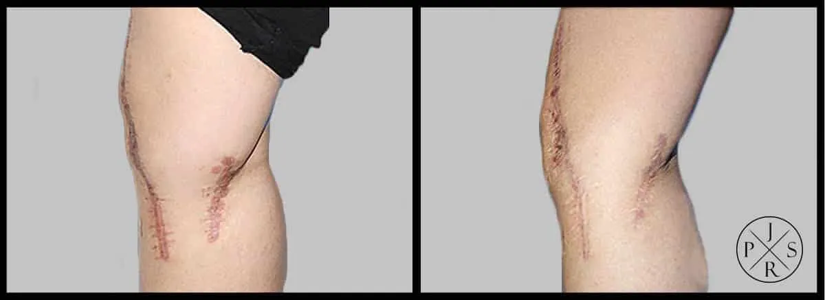 Fractional Laser Before & After - After