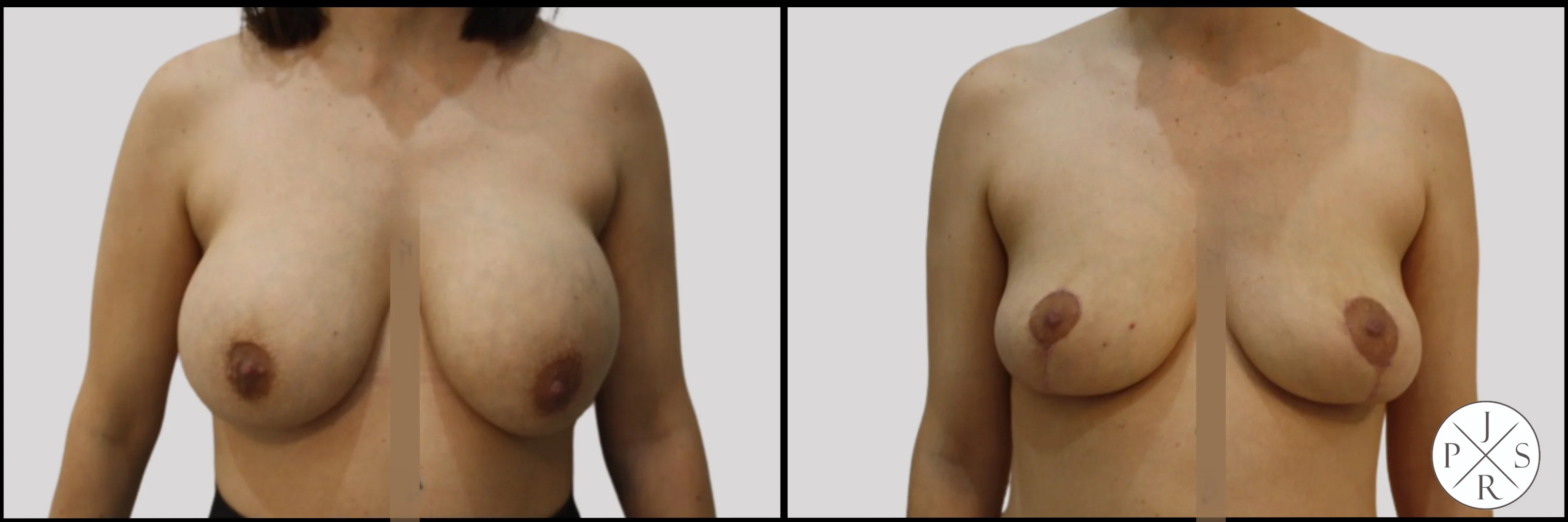 Breast Implant Removal Before & After - Front View