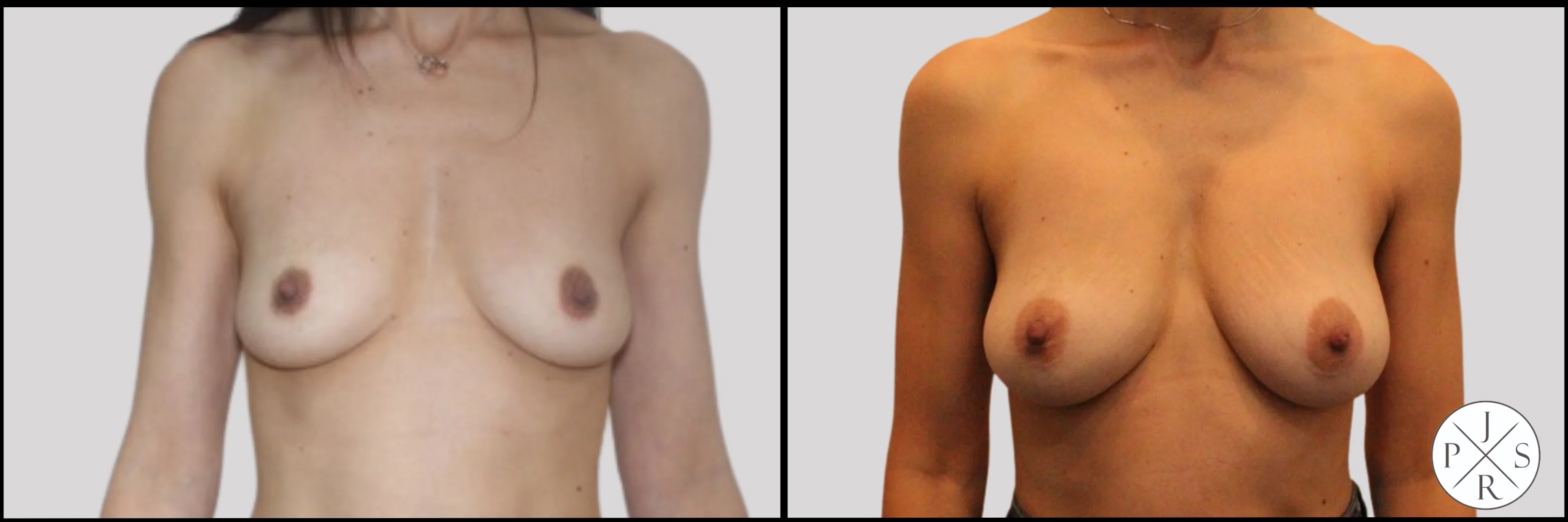 Fat Transfer Breast Augmentation Before & After - Front View