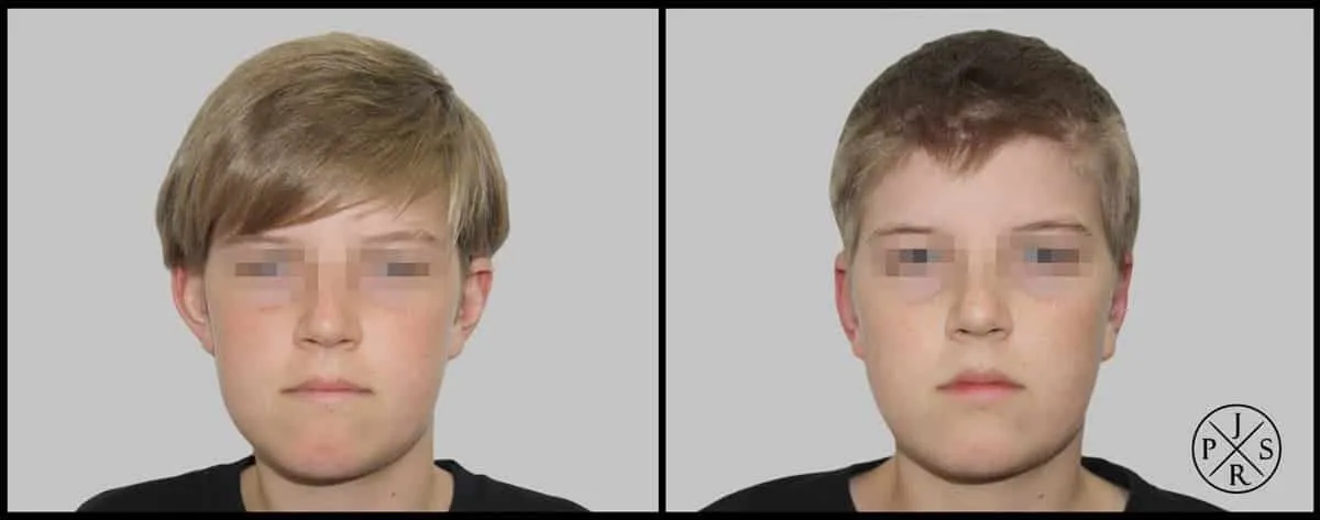 Otoplasty Before & After - Before