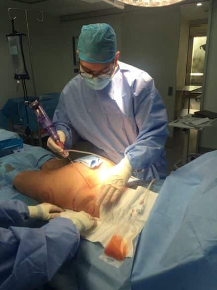 Patient receiving fat transfer in Sydney