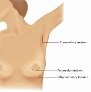 diagram of breast implant scar vs breast augmentation scar