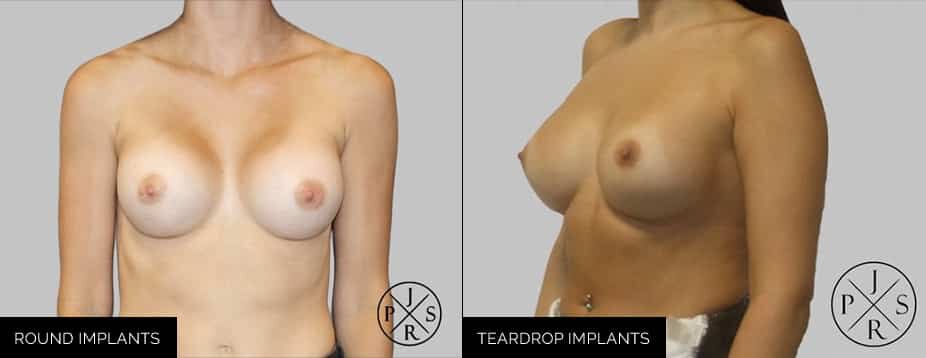 Sydney breast implant before and after