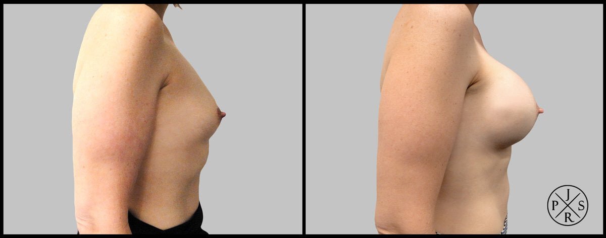 Sydney patient breast reconstruction before and after