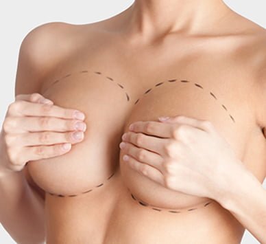 Breast fat transfer before photo
