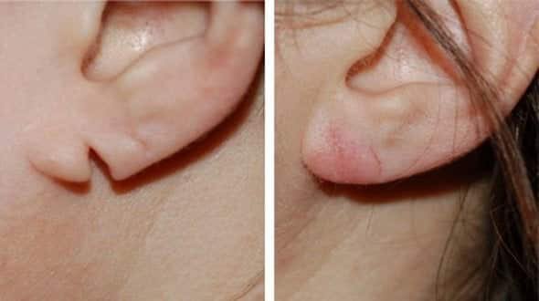 Earlobe reconstruction before and after