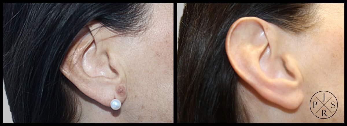 Earlobe reconstruction before and after