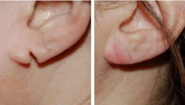 Sydney patient earlobe reconstruction before and after photos