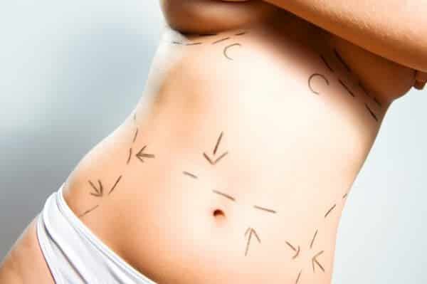 mapping out woman's body for body contouring procedure