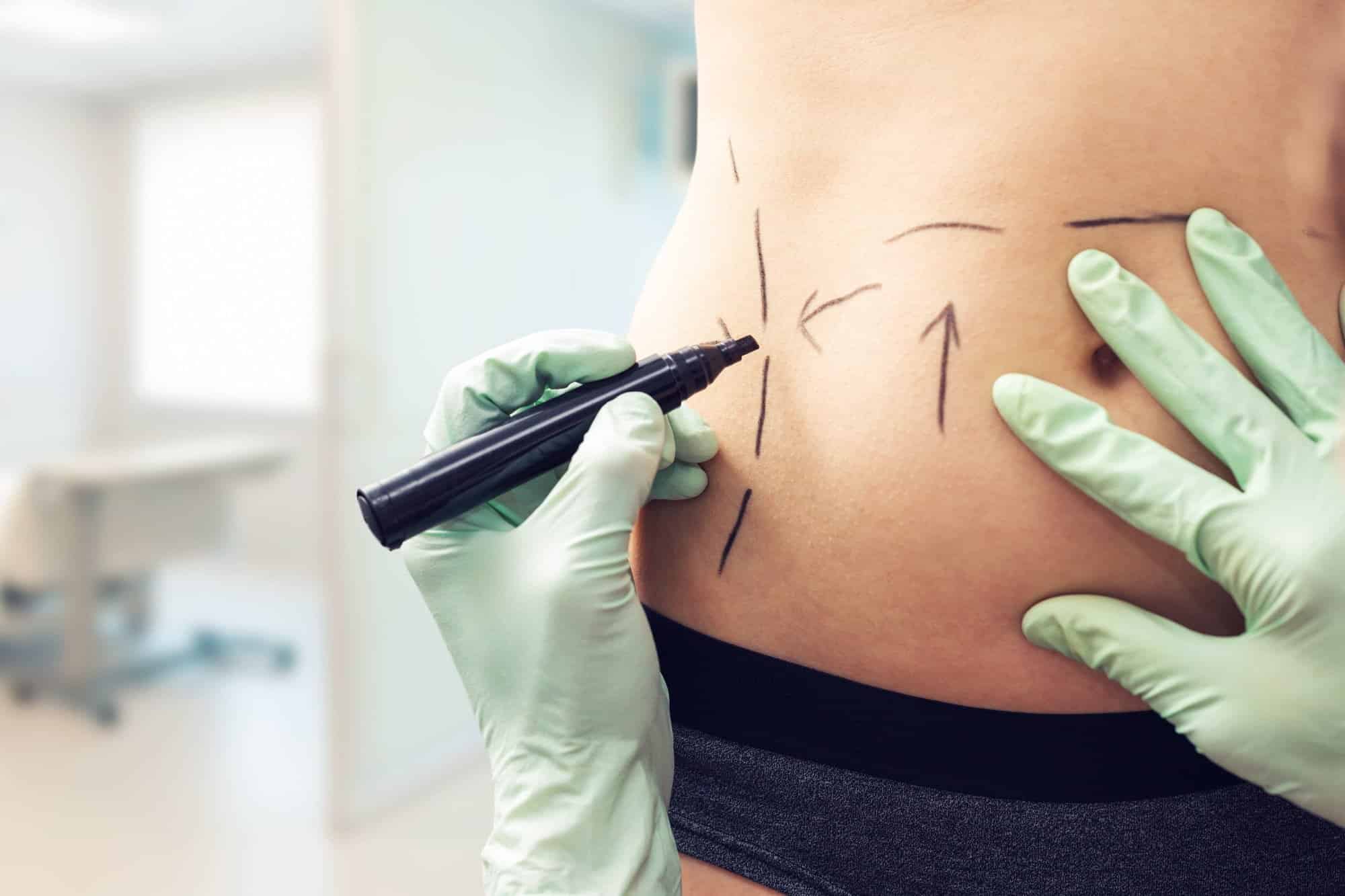 woman preparing for body contouring surgery