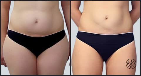 Sydney liposuction before and after photo