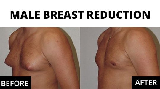 Male Breast reduction before and after photos