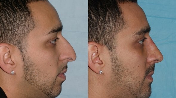 Sydney Rhinoplasty before and after photos