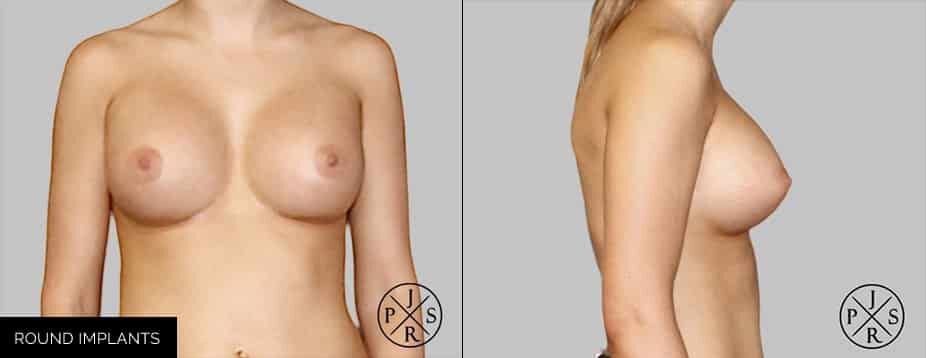 Sydney breast implant before and after