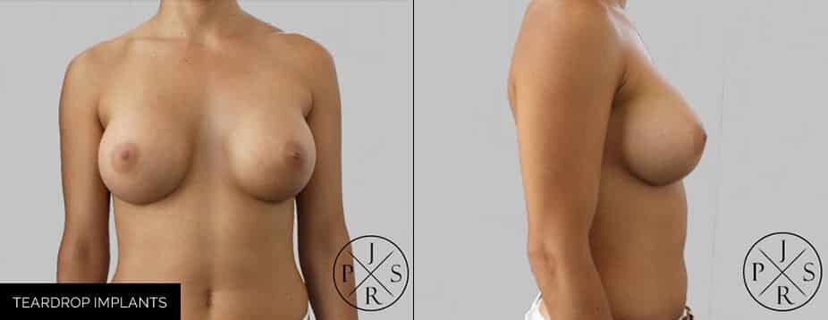 Sydney breast implant before and after