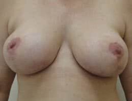 Sydney breast reduction patient after photo