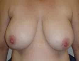 Sydney breast reduction patient before photo