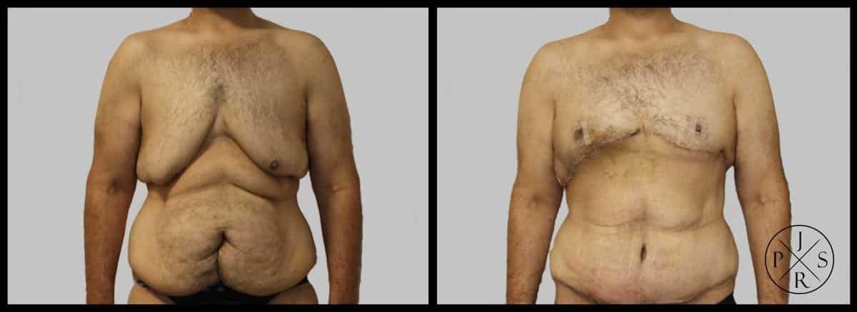 Body Lift Before & After Image