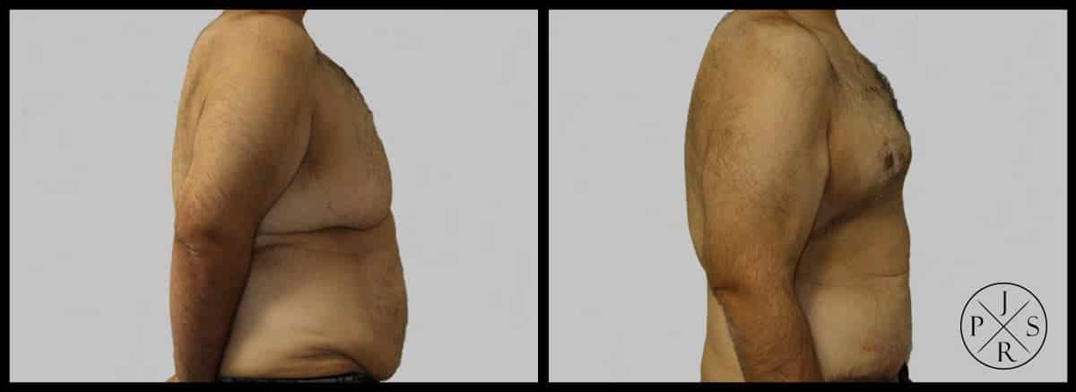 Body Lift Before & After Image