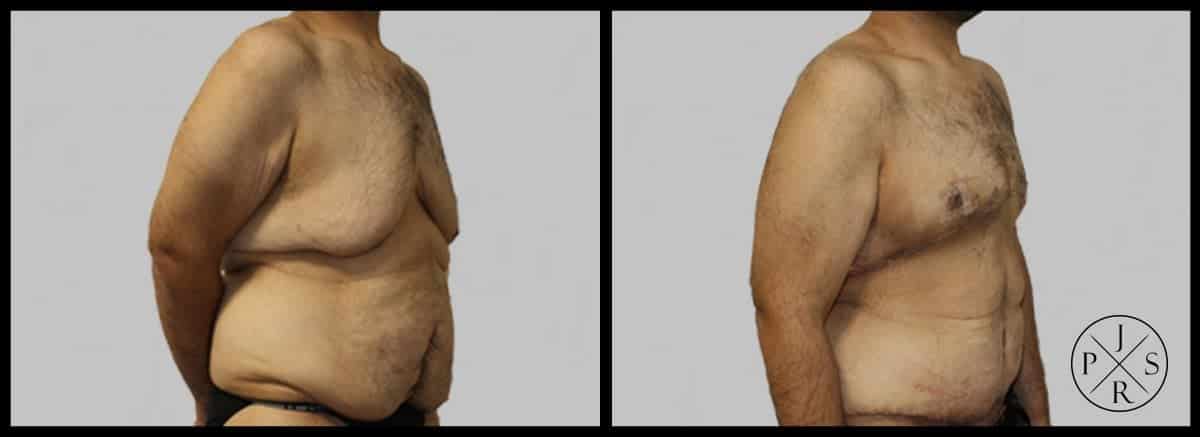 Body Lift Before & After Image